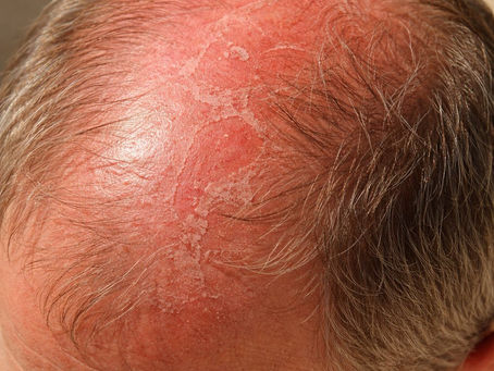 Alopecia and Scalp Skin Cancer: Why Sun Protection Matters