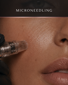 Microneedling treatment designed to improve skin texture, acne scars, pores, and collagen production.