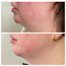 Facial balancing treatment creating improved profile harmony and natural facial proportions.