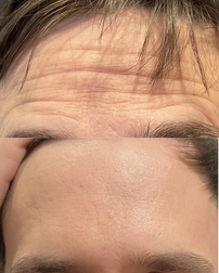 Forehead line reduction using neuromodulator treatments for smoother, refreshed-looking skin.