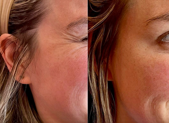 Neuromodulator treatment for crow's feet reducing fine lines around the eyes and creating a smoother, refreshed appearance while maintaining natural movement.