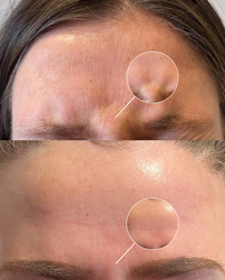 Forehead line reduction using neuromodulator treatments for smoother, refreshed-looking skin.
