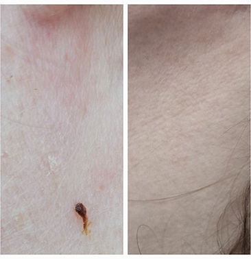 Damaged skin healed within 12 hours