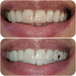 TB Before & After with added tooth gems2