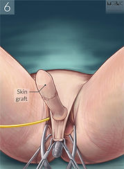 6. Skin graft (labeled).jpeg