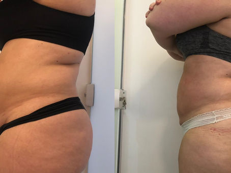Momy Slim: o novo procedimento estético voltado para mães
