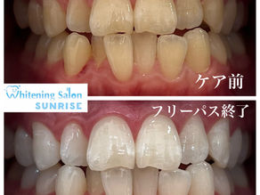 ビフォアーアフター
