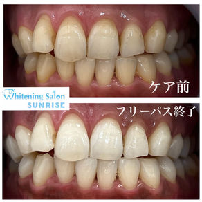 ビフォアーアフター