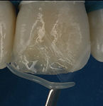 Resina composta anterior