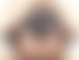 Am I a Good Candidate for Hair Restoration?