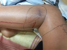 Francelys-Hernandez-mordida-por-serpiente