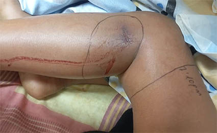 Francelys-Hernandez-mordida-por-serpiente