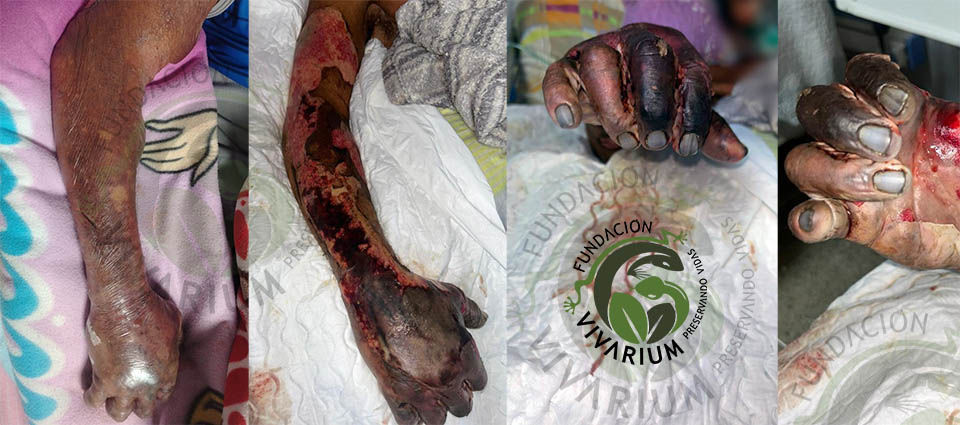 Cuatro imágenes de un brazo y manos con lesiones severas en la piel, mostrando necrosis y gangrena sobre sábanas blancas. Fondo borroso.