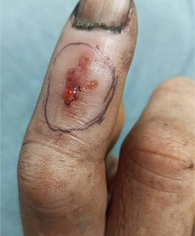 mordedura de serpiente