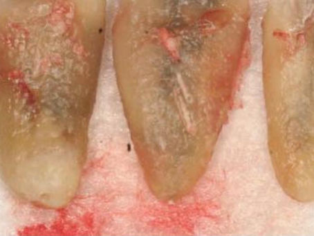 Toxins in Root Canals