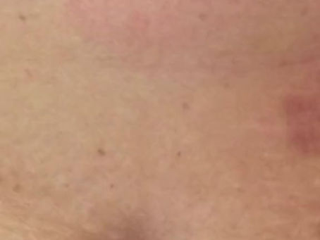 Parasites under the skin