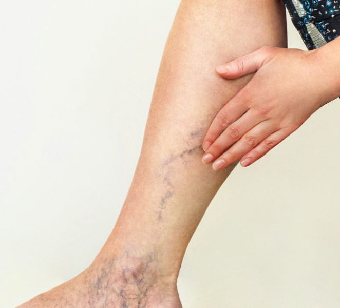 Varices