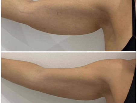 Sculpt & Tone Without Surgery: Understanding EMS & RF Treatments