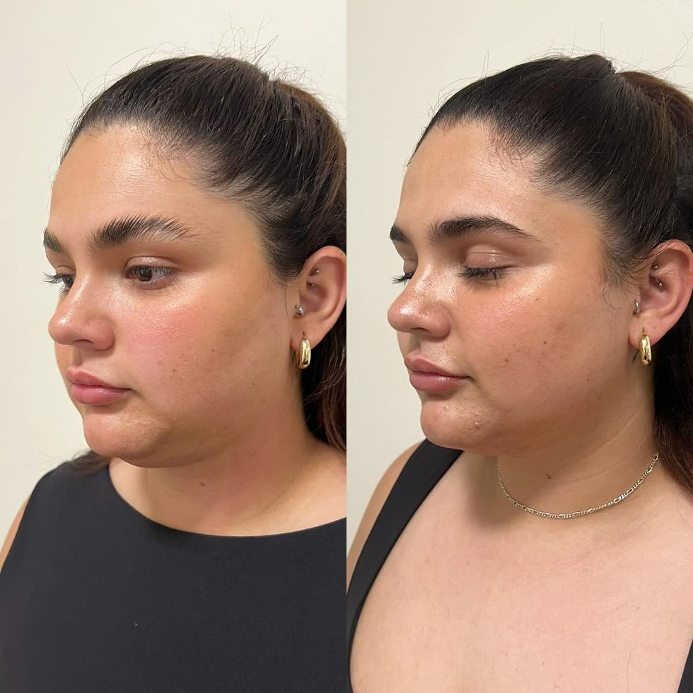 HIFU Skin Tightening: Lift, Firm & Glow Naturally
