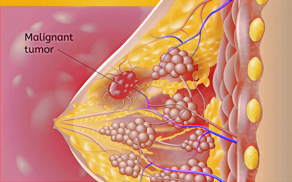 how-does-breast-cancer-spre-1080x675_edi