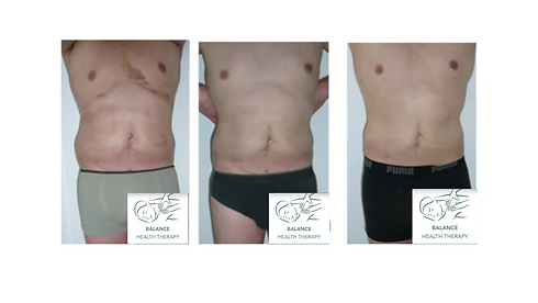 post abdominoplastie.png