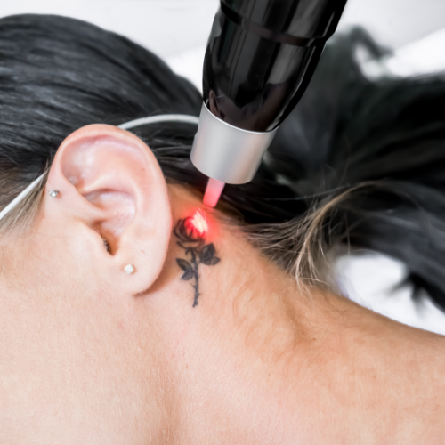 tattooremoval1.png