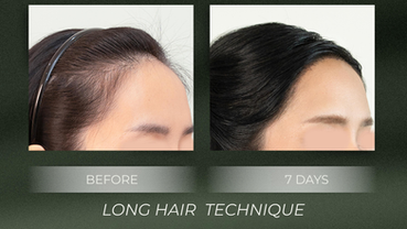 What is Long Hair transplantation? Who is it suitable for? Here are the advantages and limitations you should know before making a decision.
