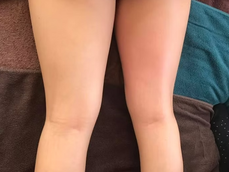 セルライト特別ケア ビフォアーアフター