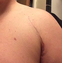 shoulder scar after 4 MPS treatments.jpg