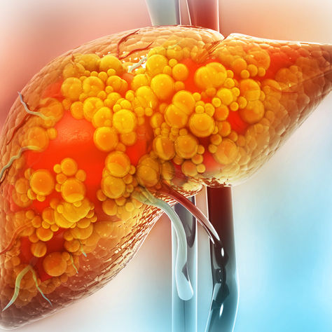 A human liver with yellow and orange fat deposits, signifying fatty liver disease.