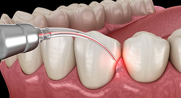 pain-free-laser-dentistry-the-dental-roots-L.jpg