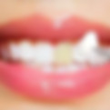 Veneers