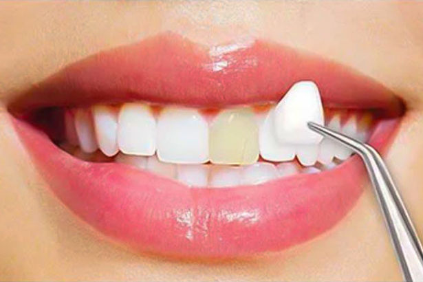 dental-veneers.jpg