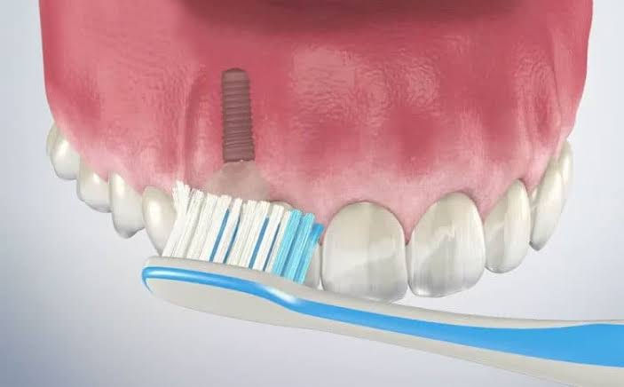 How to Maintain Your Dental Implants: Expert Advice from Dr. Yogesh Soni
