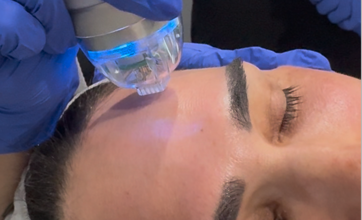 RF microneedling treatment at Platinum Salon and Spa in Gilbert AZ
