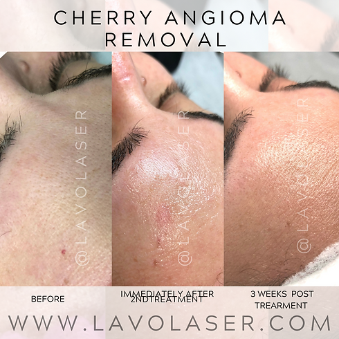 CHERRY ANGIOMA REMOVAL .png