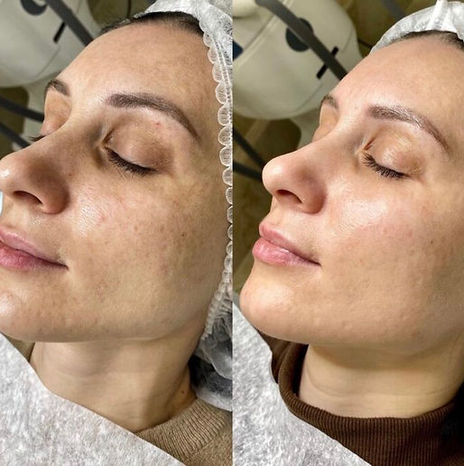 Carbon-Peel-Before-After.jpg