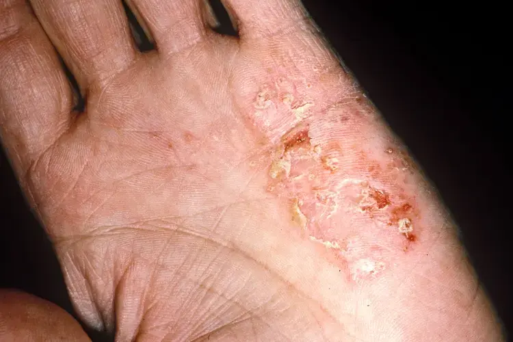 1800x1200-eczema-symptoms-causes-and-treatment-ref-guide.webp