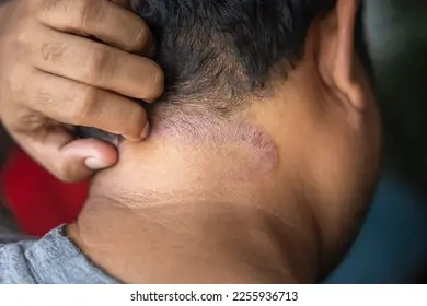 darkskinned-asian-men-suffer-scalp-260nw