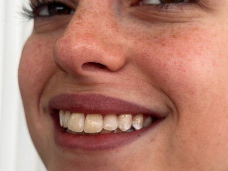What Are Those White Spots on My Teeth? Causes and Concerns Explained