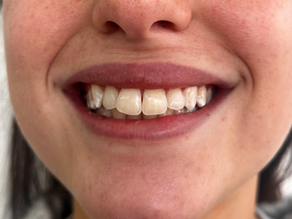 Enamel White Spot Removal