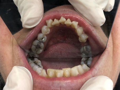 Invisable Clear Aligner Results Melbourne