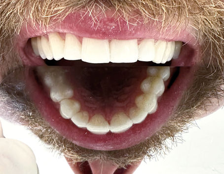 Dental Composite Bonding