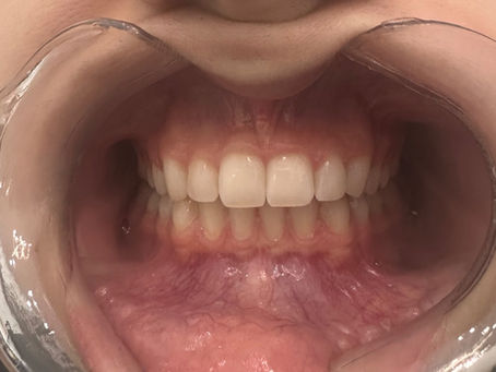 Does Invisalign Hurt? Managing Discomfort with Clear Aligners