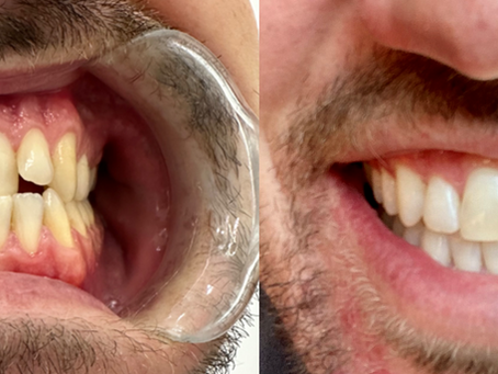 Bare Smiles Clear Aligner Results Dentist Melbourne