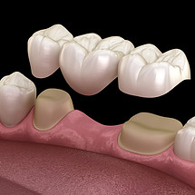 Dental Crown and Bridge.jpeg
