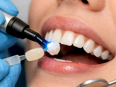 60-Minute Smile Makeover: What to Expect with Dental Bonding