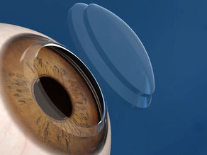 Tudo o que você precisa saber sobre a córnea