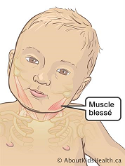 Le torticolis du nourrisson : pourquoi et que faire pour soulager votre enfant ?