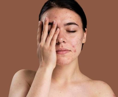 ¿Qué es el acné? causas y síntomas